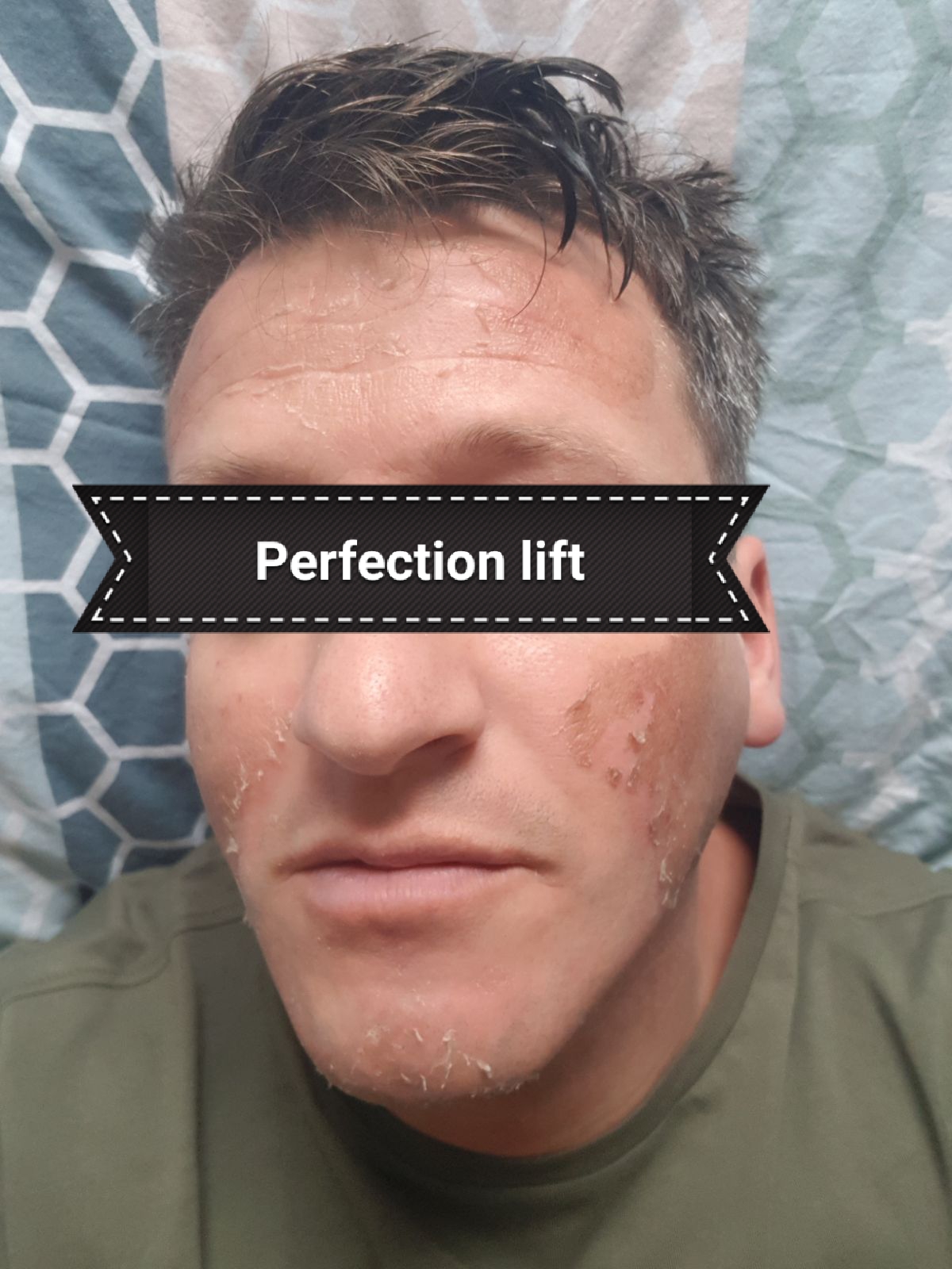 Perfection lift peeling Perfection lift peeling