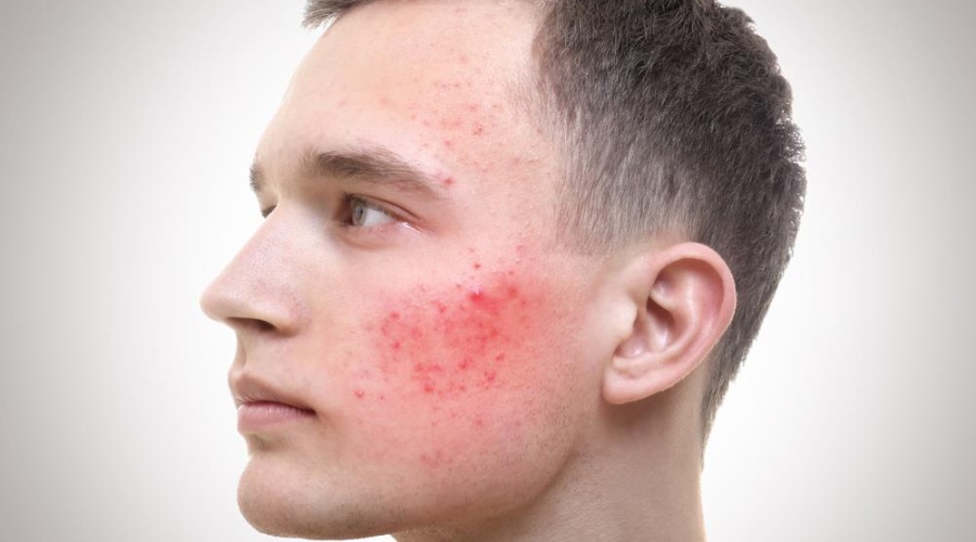 Acne