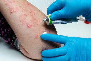 Eczeem en allergie