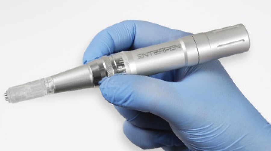 Microneedling met behulp van Enterpen