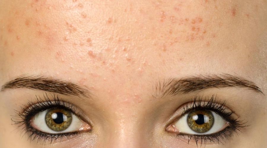 Acne en Rosacea