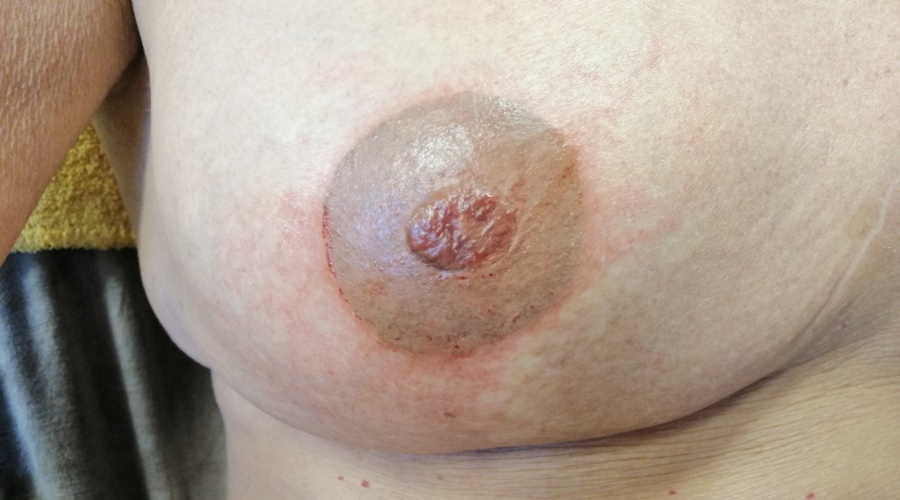 Dermatografie
