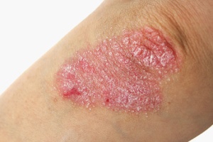 Psoriasis