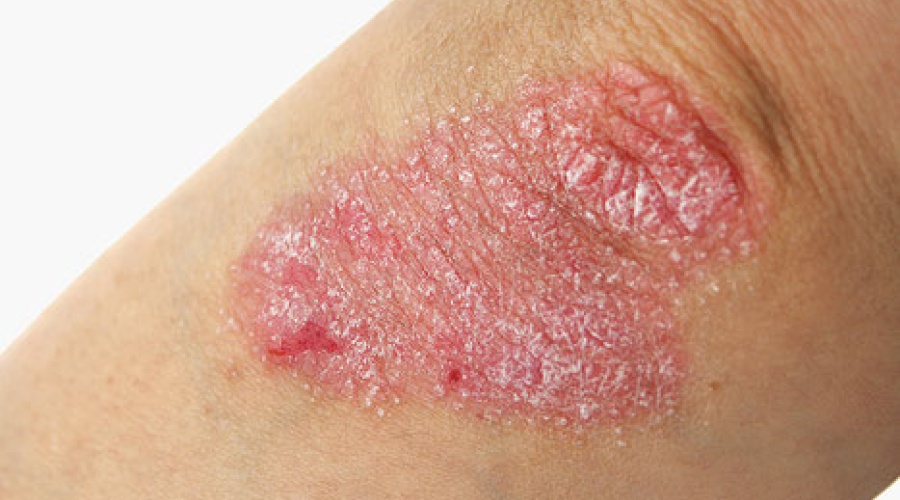 Psoriasis