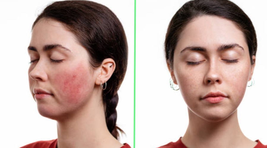 Rosacea